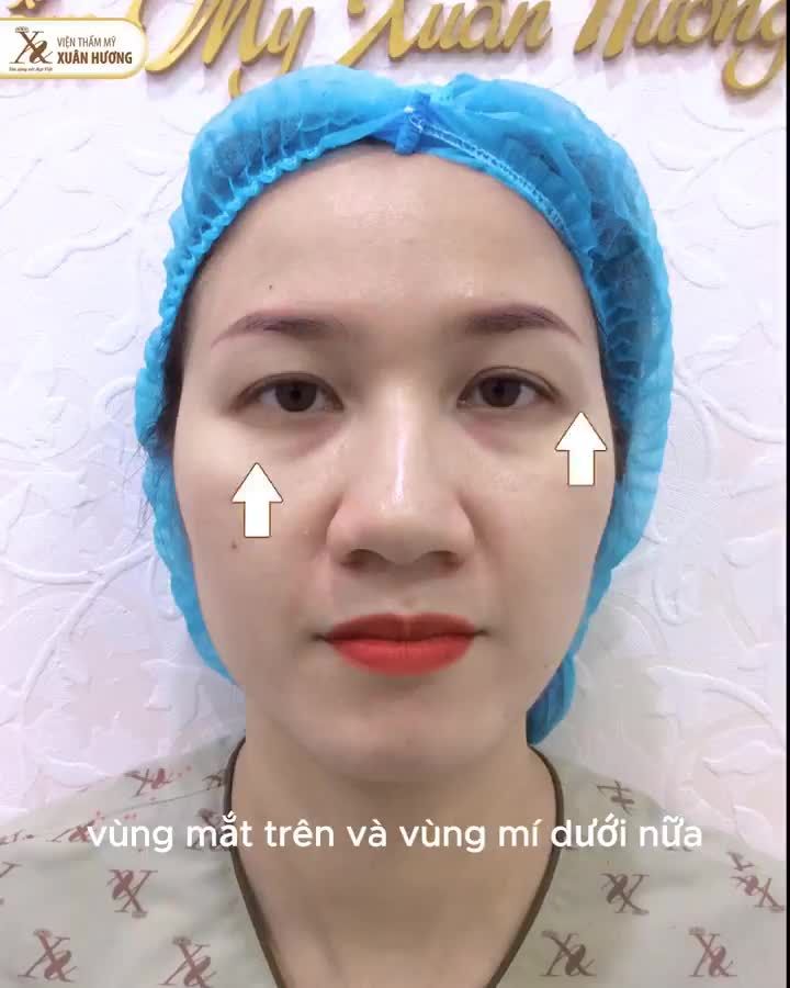 Cảm giác sau 5 ngày Nâng cung mày + Cắt mí dưới tại VTM Xuân Hương như thế nào?