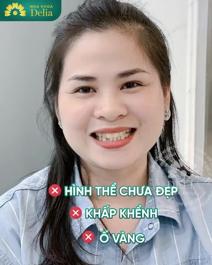 Chị Ánh Ngọc chia sẻ về trải nghiệm làm răng tuyệt vời tại ngôi nhà Delia qua video dưới đây nhé!