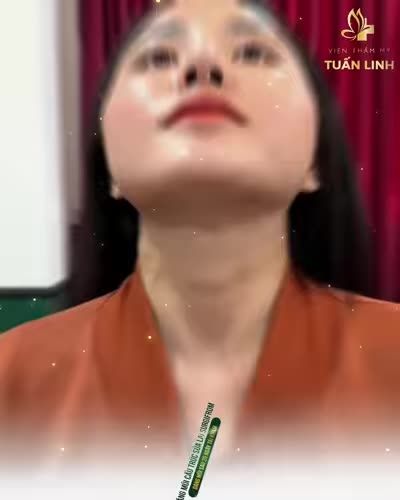Nâng mũi cấu trúc sửa lại Surgiform - Dáng mũi sau 20 ngày tái khám - ĐẸP XUẤT SẮC!!