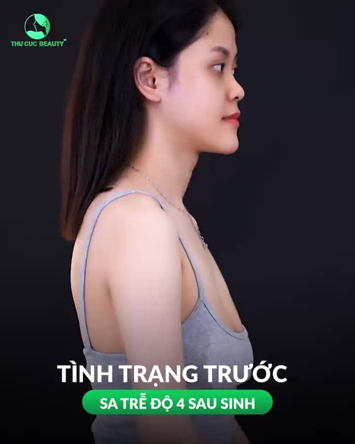 Ngực TC - Thách thức mọi cấp độ sa trễ