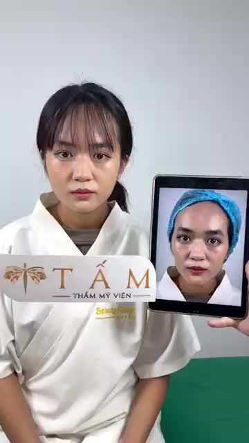 Bạn khách hàng đến tư vấn và làm dịch vụ filler thái dương, má tại phòng khám TMV Tấm.
