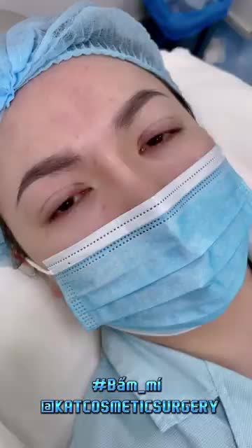 BẤM MÍ : Sự lựa chọn hoàn hảo cho các cô nàng có ít da dư và mỡ thừa, những cô nàng mắt một mí, nhiều mí lót nhưng vẫn muốn sở hữu đôi mắt hai mí to tròn.