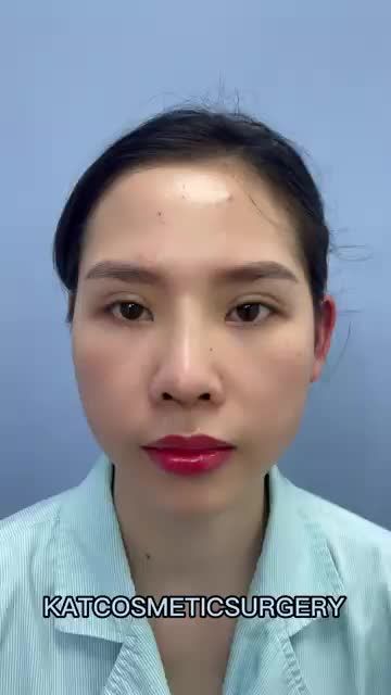 Sau phẫu thuật nâng mũi bọc sụn tự thân chiếc mũi bị hếch và thấp góc đã được thay đổi hoàn toàn bởi một dáng mũi cao thanh thoát nhưng vẫn giữ được sự tự nhiên nhất cho gương mặt .