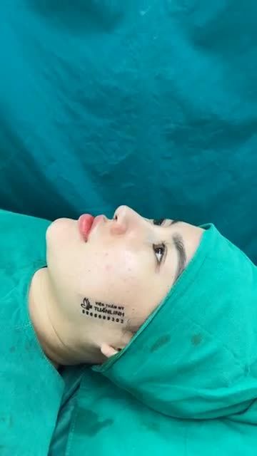 Case mũi cấu trúc sửa lại vừa hoàn thành