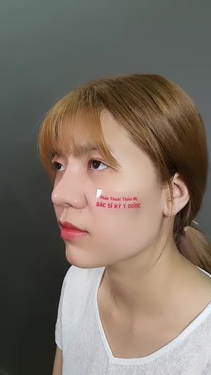 Nâng mũi có thể thay đổi bạn như thế nào?