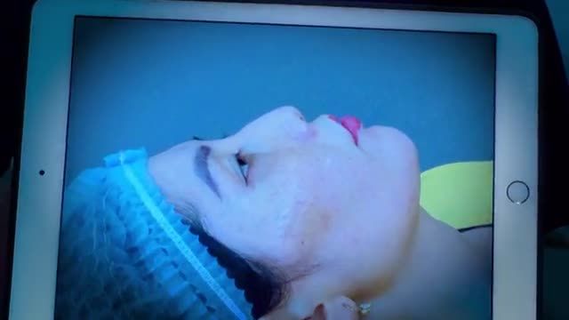 Chiêm ngưỡng ngay "tác phẩm" sau  khi khắc phục mũi bị gồ  ở góc độ nằm nghiêng của chị khách hàng dưới đây để cùng thấy được sự thây đổi của khách hàng