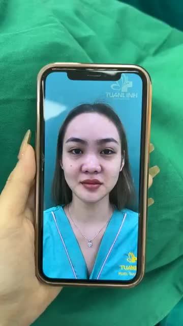 Case mũi cấu trúc vừa hoàn thành