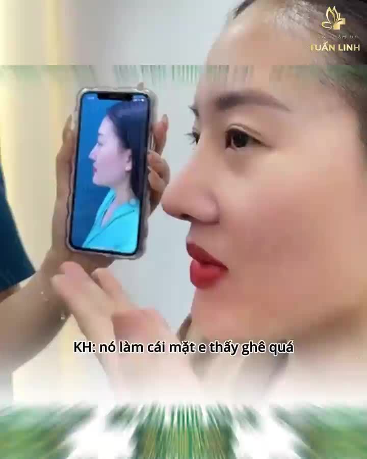 MŨI CẤU TRÚC SỬA LẠI SAU 1 THÁNG TÁI KHÁM!!
