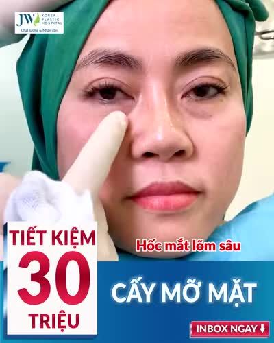 CẤY MỠ MẶT BABY FACE - TẠM BIỆT GƯƠNG MẶT KHẮC KHỔ, HỐC HÁC.