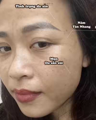 Chỉ sau 1 liệu trình cấy Meso BMC, làn da của vị khách hàng đã trở lên rạng rỡ như thế nào?