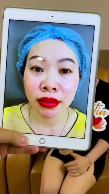Nâng mũi sau 10 ngày trông sẽ như thế nào? Cả nhà cùng theo dõi