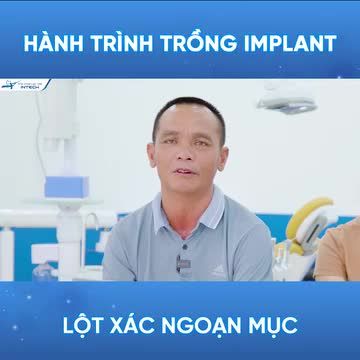 HÀNH TRÌNH TRỒNG RĂNG IMPLANT TOÀN 2 HÀM - LỘT XÁC NGOẠN MỤC