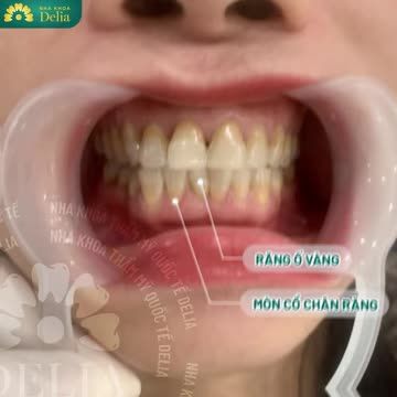 Chị Ninh Hương đến nha khoa Delia với mong muốn khắc phục tình trạng răng ố vàng, mòn cổ chân răng gây kém tự tin trong giao tiếp.