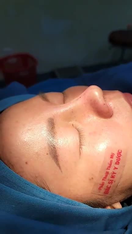 Kết quả Nâng mũi Aline sụn tại hai lớp kết hợp Treo cánh mũi.