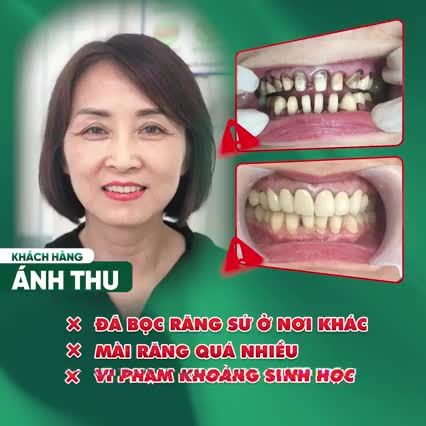 KHÔNG THỂ TIẾP TỤC VỚI HÀM RĂNG BIẾN CHỨNG DO BỌC SỨ KIM LOẠI, CHỊ ÁNH THU QUYẾT ĐỊNH XUỐNG HÀ NỘI ĐỂ TÂN TRANG NỤ CƯỜI