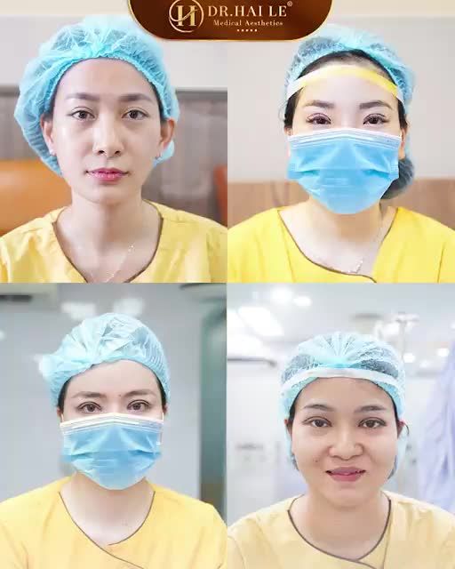 Trao niềm tin cho các cơ sở thẩm mỹ kém uy tín - Tiền mất tật mang, cuộc sống bị đảo lộn, bạn "rốp rẻng" tìm địa chỉ uy tín để khắc phục đôi mắt lỗi, hỏng!
