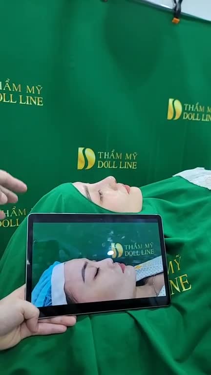 Mũi Doll line sugi  mũi đã nâng chỉ