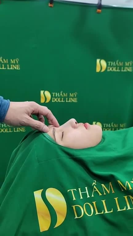 Mũi Doll line , bóc xơ filler