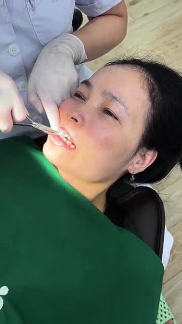 QUÁ TRÌNH ĐI DÂY CUNG NIỀNG RĂNG CHO KHÁCH HÀNG U40