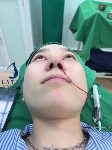 Dáng mũi cao tây cho em gái từ Nhật về Việt Nam làm đẹp