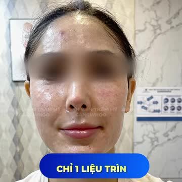 CẬP NHẬT THÔNG TIN TIÊM MESOTHERAPY TRONG ĐIỀU TRỊ DA