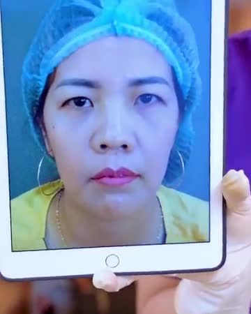 Trẻ ra 5-10 chỉ nhờ thẩm mỹ mắt tại Dr.Hải Lê bạn có tin? Theo dõi ngay