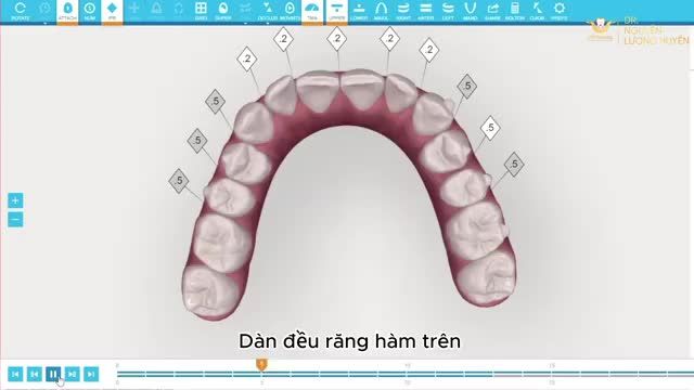Niềng răng khay trong suốt số 1 thế giới điều trị tình trạng răng khấp khểnh, khớp cắn sâu như thế nào?