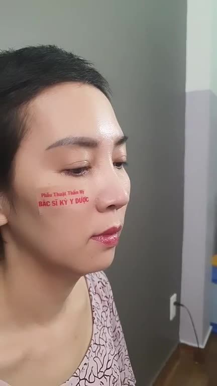 Kết quả sau 1 năm nâng mũi Aline tại Bác sĩ Kỳ Y Dược.