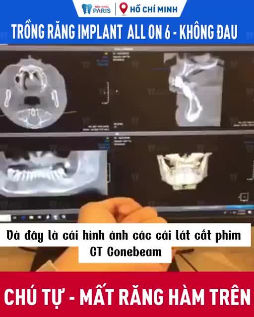 Tôi mới trồng cái răng Implant 6 trụ sáng nay, cũng không thấy đau, bình thường, bác sĩ chăm sóc rất kỹ và yêu cầu tôi nằm nghỉ 2 tiếng, thì giờ ổn rồi”