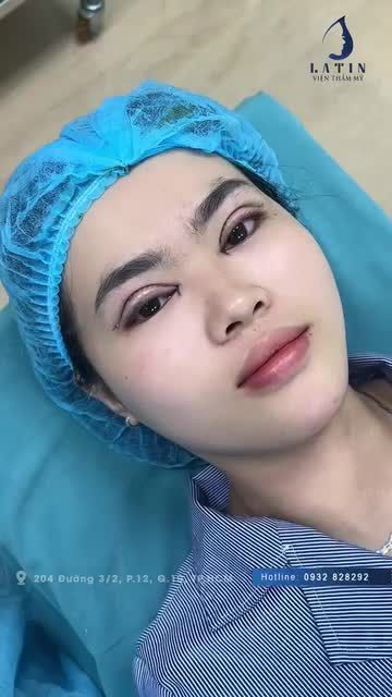 Em gái bị nhược cơ, mắt mí lót, 2 mắt không đều nhau bẩm sinh, làm cho gương mặt buồn kém xinh.