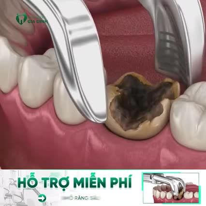HỖ TRỢ MIỄN PHÍ NHỔ RĂNG SÂU CHO TẤT CẢ KHÁCH HÀNG