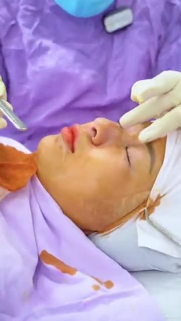 Hô biến dáng mũi thấp tẹt trở nên cao tây sang chảnh tại Dr.Hải Lê