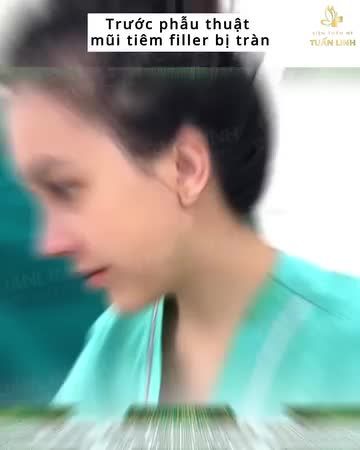Đừng tiêm filler nữa...Mình nâng mũi đi khách ơi.