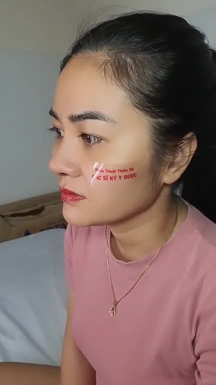 Nâng Mũi ALINE Sụn Tai 2 Lớp sau 17 ngày tại Nha Trang