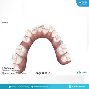 CLINCHECK trong chỉnh nha invisalign