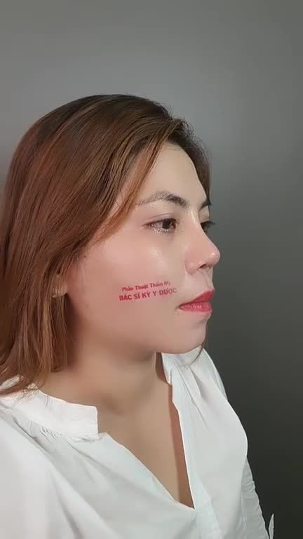 Sau 5 tháng Nâng Mũi ALINE, bạn khách đã có sự thay đổi ngoạn mục. Mời cả nhà theo dõi hình ảnh hiện tại của bạn ấy nhé!