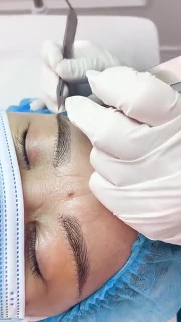 Rút chỉ nâng cung mày sau 5 ngày