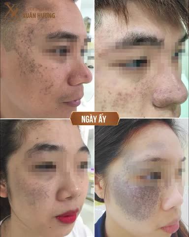 XÓA SẠCH CHÀM BỚT - TỰ TIN DIỆN MẠO MỚI