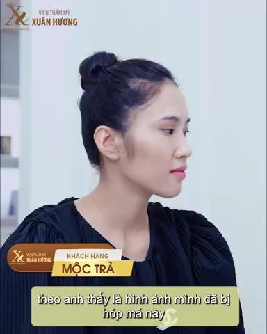 Khách hàng từng đưa dưỡng chất tạo hình tại cơ sở khác nhưng do tay nghề người thực hiện chưa đảm bảo và dưỡng chất không chính hãng nên khuôn mặt bị sưng, bầm tím và vùng da bị vón cục,...