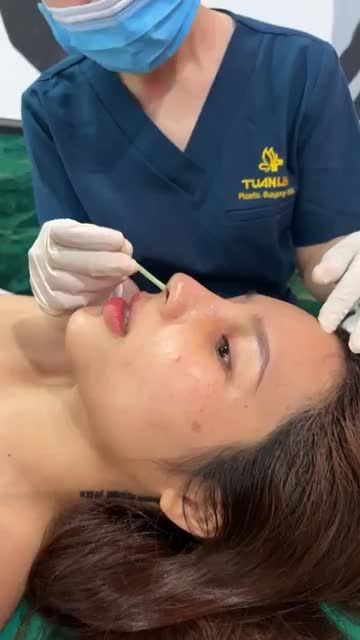 Case mũi bọc sụn được 5 ngày