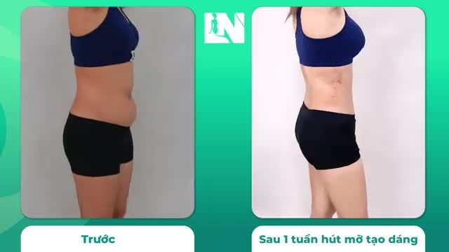Sự thay đổi của dáng vóc sau ca  hút mỡ tạo dáng thẩm mỹ