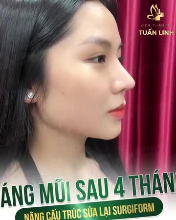 Cảm nhận sau 4 tháng nâng mũi của cô nàng Hotgirl 9X!!