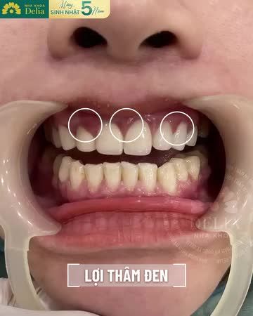 Xử lý răng sứ hỏng - Kiến tạo nụ cười khỏe đẹp tự tin