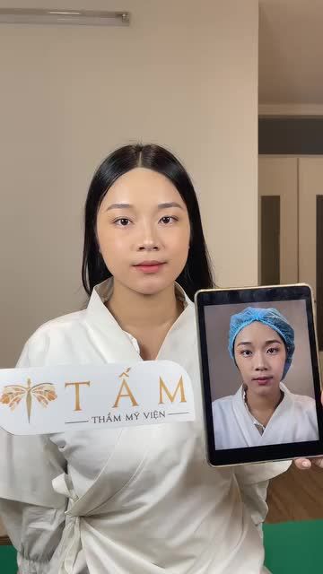 Tại phòng khám TMV Tấm, gương mặt bạn khách sau 30 phút cân chỉnh bằng Filler đã trở nên đầy đặn, bầu bĩnh, cải thiện rất nhiều so với hình ảnh má hóp ban đầu.