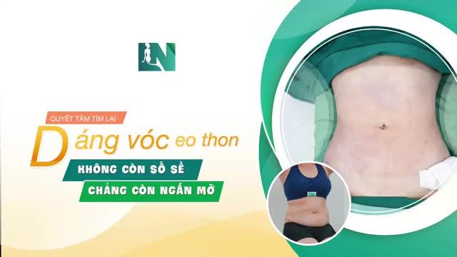 Hình ảnh thay đổi của trường hợp Chị Khách hàng Nhâm – đến từ Bình Phước sau ca  hút mỡ tạo dáng thẩm mỹ.