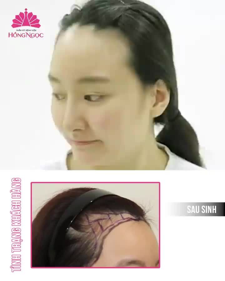 CƠ HỘI DUY NHẤT CẤY TÓC CÙNG CHUYÊN GIA ƯU ĐÃI 50%