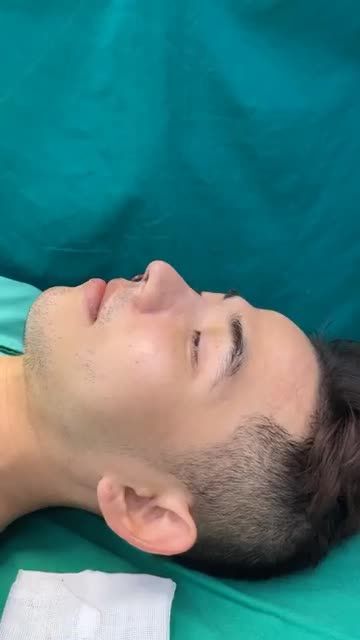 Case mũi cấu trúc bóc chỉ vừa hoàn thành