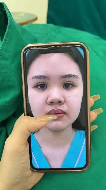 Case mũi cấu trúc vừa hoàn thành