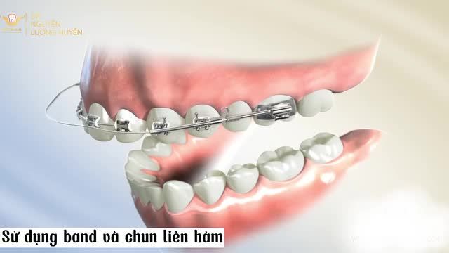NIỀNG RĂNG KHÔNG NHỔ RĂNG ĐIỀU TRỊ RĂNG HÔ, KHỚP CẮN SÂU RA SAO?