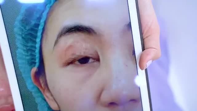Mí lỗi hỏng được Dr.Hải Lê chỉnh hình thành công như thế nào? Theo dõi ngay
